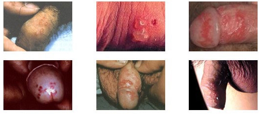 生殖器疱疹老是复发的原因